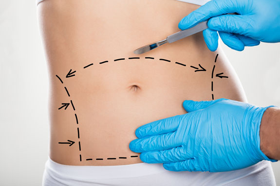 Abdominoplastik Ingolstadt
